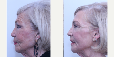 Case 6137 - 65-74 year old woman treated with Eyelid Surgery, Halo Laser, Botox