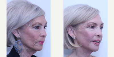 Case 6138 - 65-74 year old woman treated with Eyelid Surgery, Halo Laser, Botox