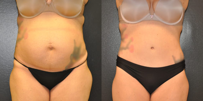 Case 614 - 29 year old woman treated with Tummy Tuck