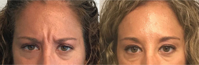 Case 6143 - Woman treated with Botox