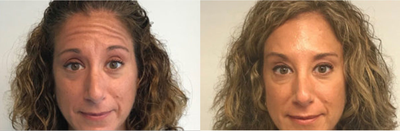 Case 6144 - Woman treated with Botox