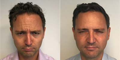 Case 6145 - Man treated with Botox