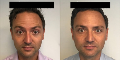 Case 6146 - Man treated with Botox