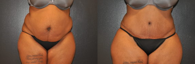 Case 615 - 26 year old woman treated with Tummy Tuck