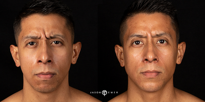 Case 6156 - 25-34 year old man treated with Botox