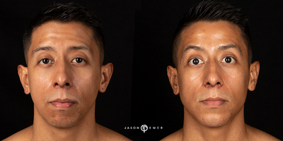 Case 6157 - 25-34 year old man treated with Botox