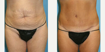 Case 616 - Woman treated with Tummy Tuck