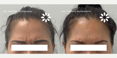 Case 6169 - 45-54 year old woman treated with Botox