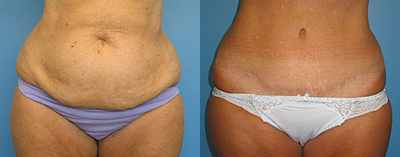 Case 617 - Woman treated with Tummy Tuck