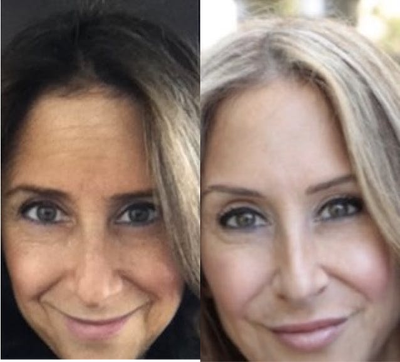 Case 6170 - Woman treated with Botox