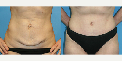 Case 618 - Woman treated with Tummy Tuck