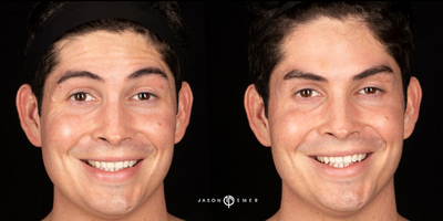 Case 6180 - 25-34 year old man treated with Botox