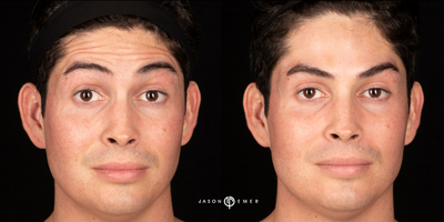 Case 6181 - 25-34 year old man treated with Botox