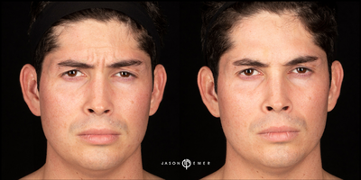 Case 6182 - 25-34 year old man treated with Botox