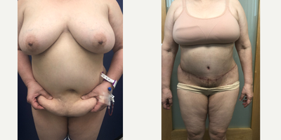 Case 619 - 55-64 year old woman treated with Tummy Tuck