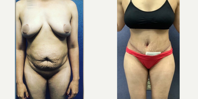 Case 620 - 35-44 year old woman treated with Tummy Tuck