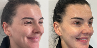 Case 6216 - 25-34 year old woman treated with Botox