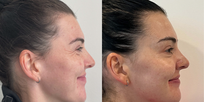 Case 6217 - 25-34 year old woman treated with Botox