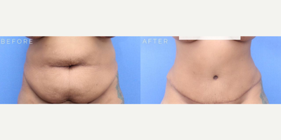 Case 622 - Woman treated with Tummy Tuck