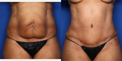 Case 623 - 35-44 year old woman treated with Tummy Tuck