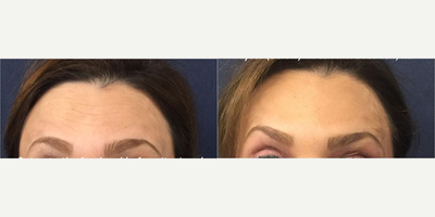 Case 6234 - Woman treated with Botox