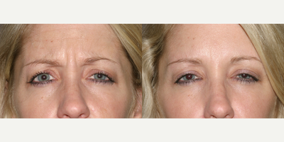 Case 6239 - 35-44 year old woman treated with Botox