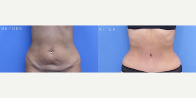 Case 624 - Woman treated with Tummy Tuck