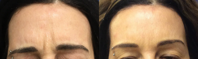 Case 6285 - 45-54 year old woman treated with Botox