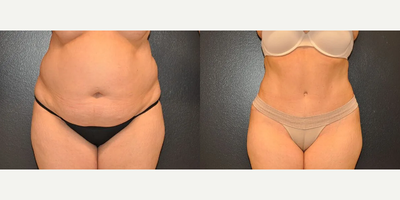 Case 63 - Woman treated with Tummy Tuck