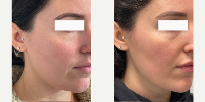 Case 6315 - 25-34 year old woman treated with Botox