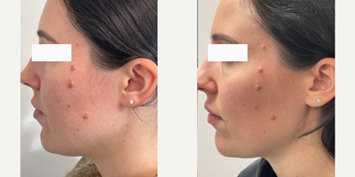 Case 6316 - 25-34 year old woman treated with Botox