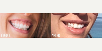 Case 6326 - Woman treated with Botox