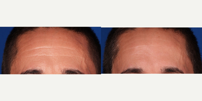 Case 6327 - 45-54 year old man treated with Botox for Forehead Wrinkles, Frown Lines