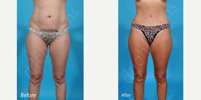 Case 633 - 35-44 year old woman treated with Tummy Tuck