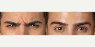 Case 6334 - 25-44 year old man treated with Botox