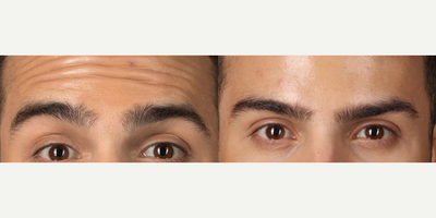 Case 6335 - 25-44 year old man treated with Botox