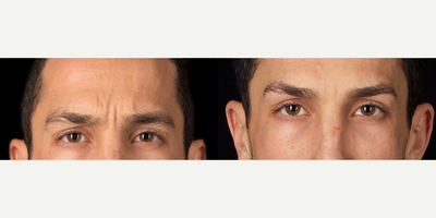 Case 6336 - 35-44 year old man treated with Botox