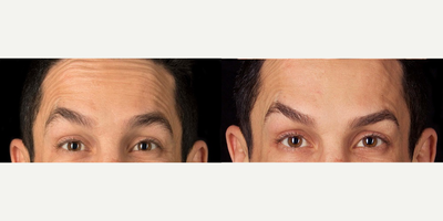 Case 6337 - 35-44 year old man treated with Botox