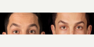 Case 6338 - 35-44 year old man treated with Botox