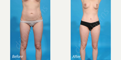 Case 634 - 25-34 year old woman treated with Tummy Tuck