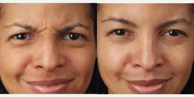 Case 6344 - Woman treated with Botox