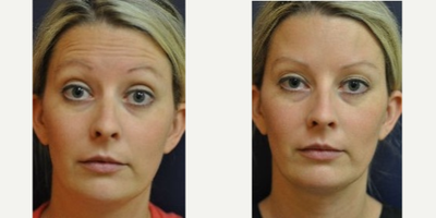 Case 6345 - Woman treated with Botox