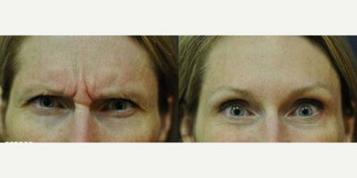 Case 6346 - Woman treated with Botox