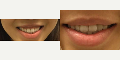 Case 6347 - 25-34 year old woman treated with Botox