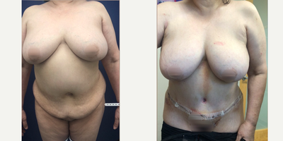 Case 635 - 55-64 year old woman treated with Tummy Tuck