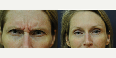 Case 6350 - 45-54 year old woman treated with Botox