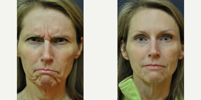 Case 6351 - 45-54 year old woman treated with Botox