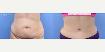 Case 636 - Woman treated with Tummy Tuck