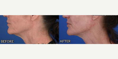 Case 6376 - 25-34 year old woman treated with Botox