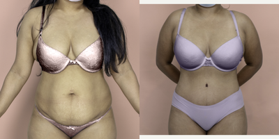 Case 638 - 35-44 year old woman treated with Tummy Tuck